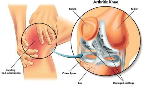 ArthritisTotalkneereplacement