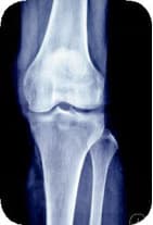 Osteoarthritis
